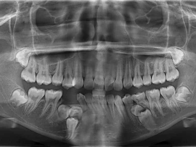 Oral Panatomogram